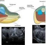 ביופסיית ערמונית