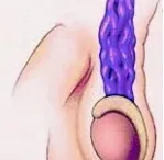 תיקון ואריקוצל