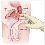 כריתת ערמונית